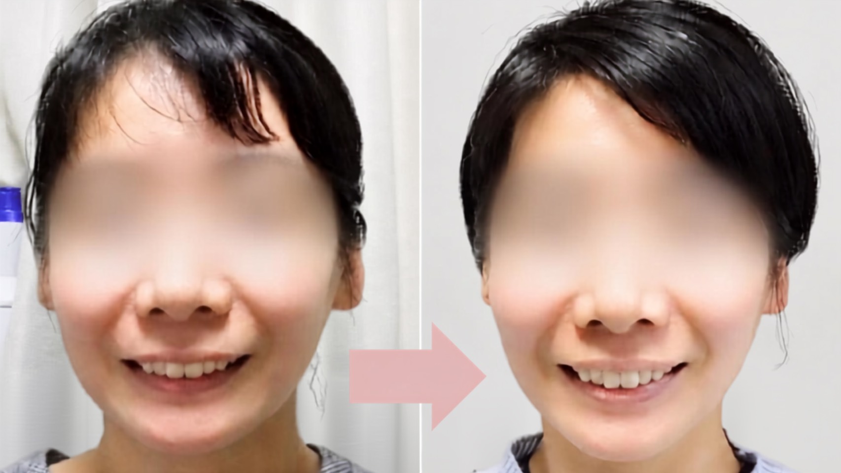 Mさんのビフォーアフター